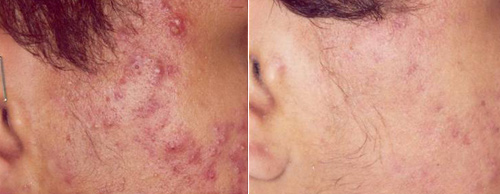 Photodynamic Acne Treatments Using Levulan (ALA/PDT)